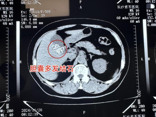 口味重易得胆结石？刘女士在京石医院的取石教训！(图1)