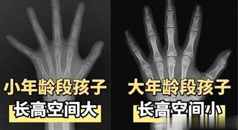 “矮个子”5个特征，孩子占越多越难长高，家长别忽视！(图1)
