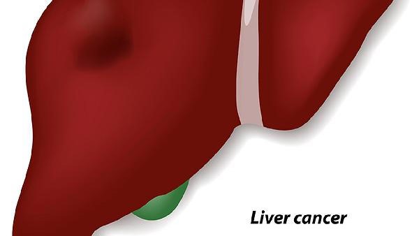 肝癌有几个不明显表现，许多人误以为是颈椎疾病，发现时已是晚期(图1)
